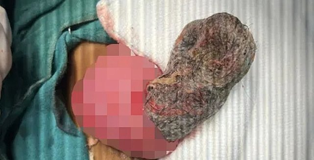 4 Yaşındaki Kızın Midesinden Şaşırtan Saç Yumağı Çıktı